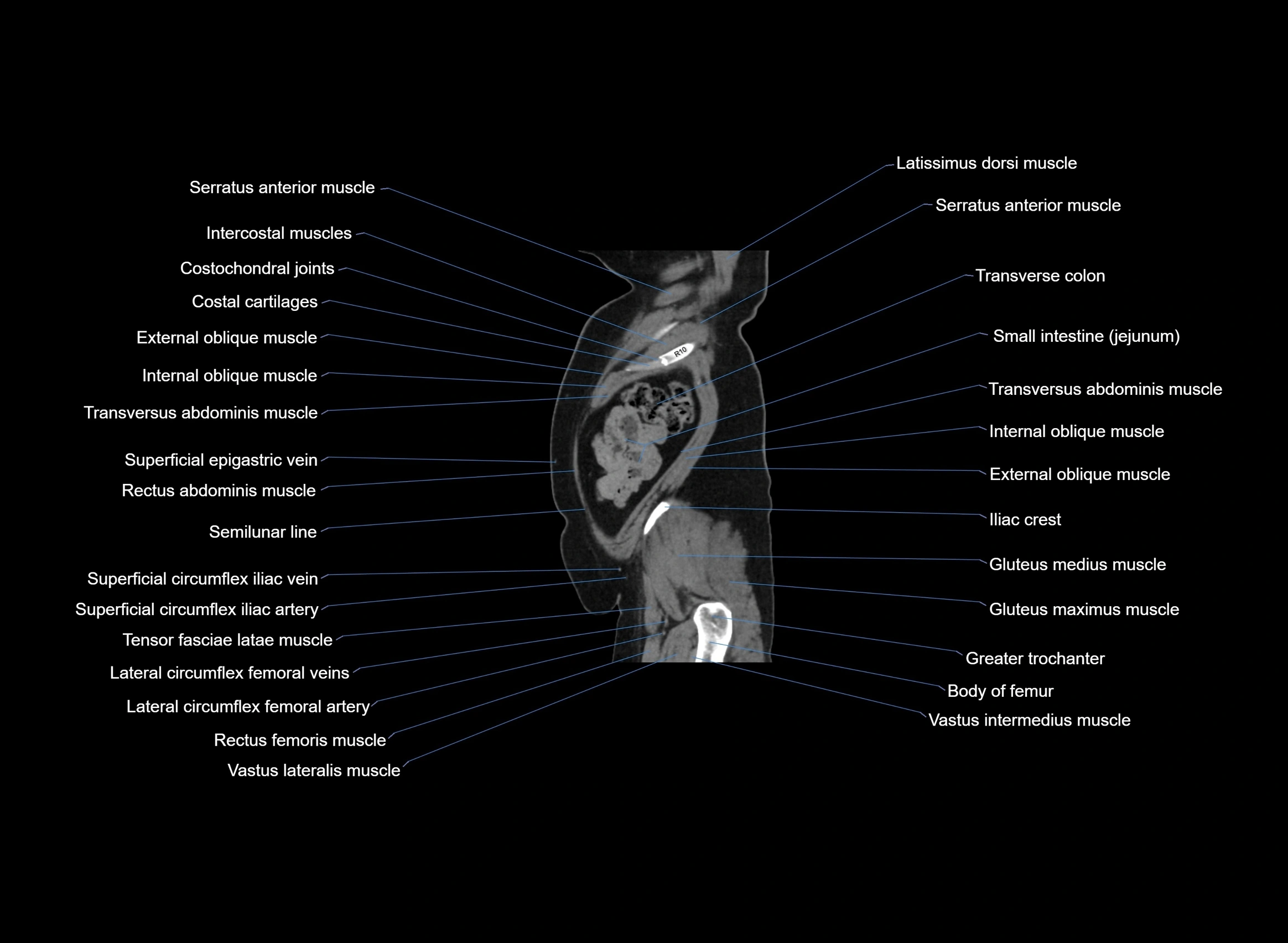 CT Abdomen sagittal cross sectional anatomy labelled radiology image -00014.webp